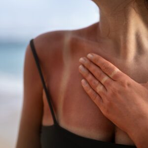 Scottature solari: rimedi immediati per proteggere la tua pelle