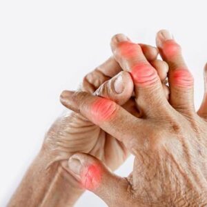 Artrosi: come alleviare i sintomi