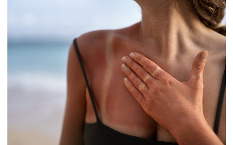 Scottature solari: rimedi immediati per proteggere la tua pelle