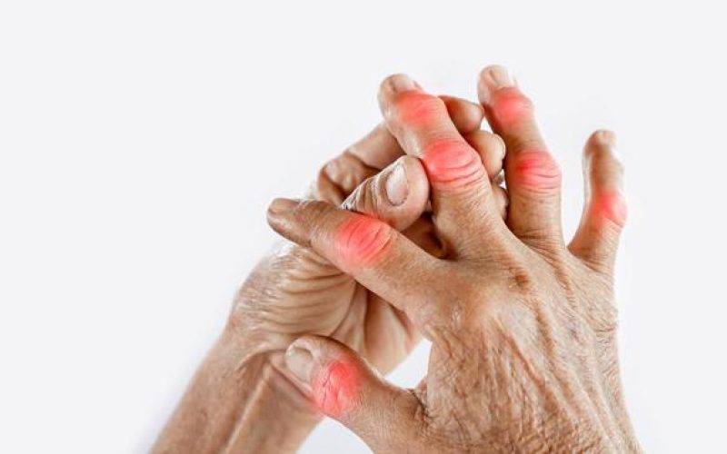 Artrosi: come alleviare i sintomi Artrosi: come alleviare i sintomi